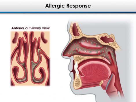 Allergy Cross-section